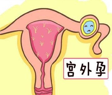 早期宫外孕怎么检查？6个检查帮助确诊