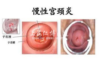 上海建国医院宫颈炎